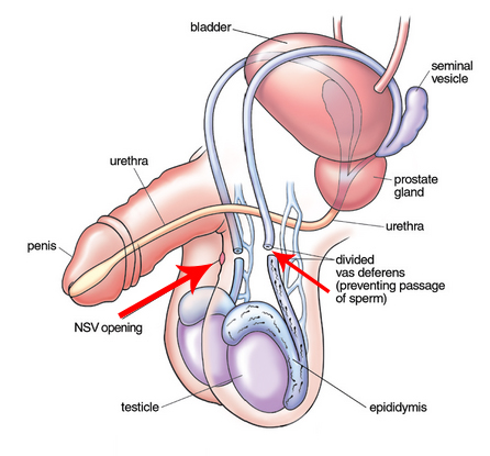 vasectomy pic